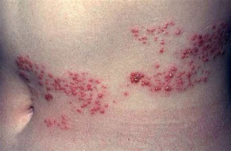 Shingles Rash Pictures