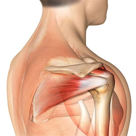 Rotator Cuff Tears Diagnosis, Symptoms, and Treatment