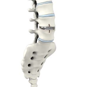 Lumbar Artificial Disc Replacement | Advanced Orthopaedics & Sports Medicine, Orthopaedic ...