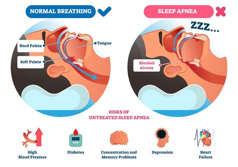 Sleep Apnea | Lakeside Medical Supplies | Vernon, BC