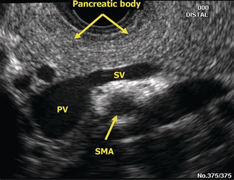 Superior Mesenteric Vein Ultrasound