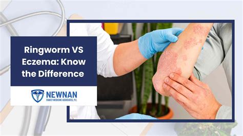 Ringworm VS Eczema: Know the Difference