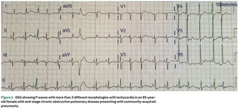 Multifocal Atrial Tachycardia: A Classic Electrocardiogram