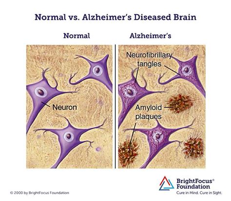 Early diagnosis of malfunctioning human neural networks by artificial neural networks. | by Anik ...