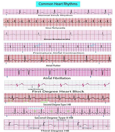 See this Instagram photo by @medical.doctors • 778 likes | Ekg interpretation, Ekg, Ekg rhythms