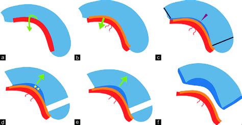 Diagrammatic illustration of the right medial temporal anatomy and the ...