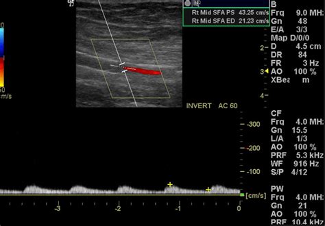 Arterial Duplex Ultrasonography – The Society for Vascular Medicine