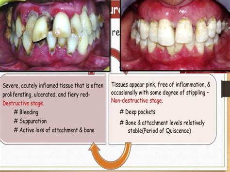 Aggressive Periodontitis