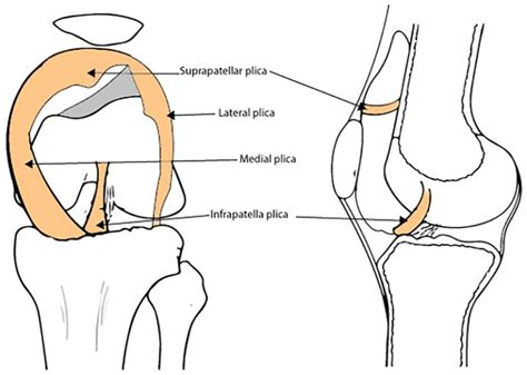 Plica Knee Condition | David Slattery