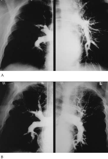 Reoperative pulmonary thromboendarterectomy - The Annals of Thoracic ...