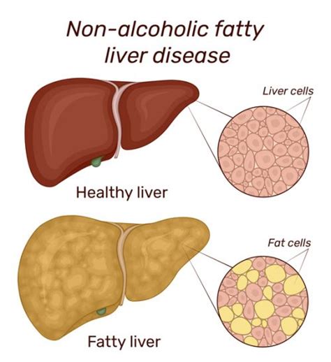 Non Alcoholic Fatty Liver - Academy of Wellness