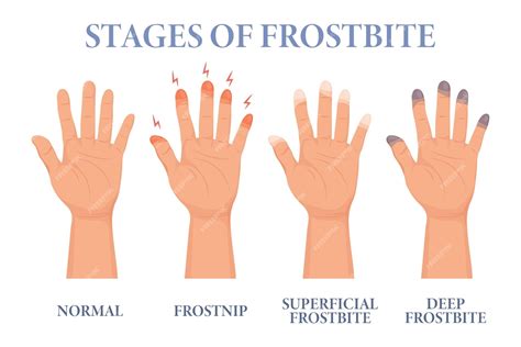 Premium Vector | Frostbite stages. frozen hands in different stages ...