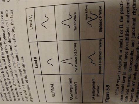 P wave to physiologic abnormalities | P wave, Waves, Deep and wide