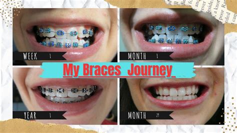 Braces monthly progress | Before and after Time-lapse | Orthodontic ...