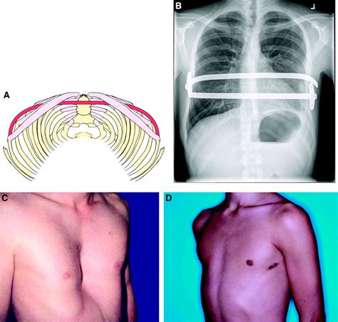 Pectus Current Management Of Pectus Excavatum A Review And Update Of ...