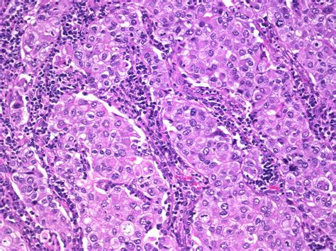 medullary carcinoma breast histology