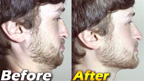 Crazy Jawline Transformation BEFORE and AFTER - Jawline Exercises - YouTube