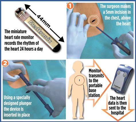 The boys who've been injected with their own heart monitors: British first as 3G implants ...