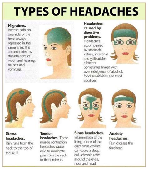 This is good to know... Migraines Remedies, Natural Headache Remedies ...