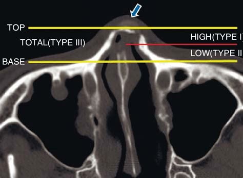 Nasal Bone Anatomy Ct Radiology : Technology and Techniques in ...