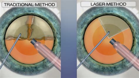 Cataract Treatment Options | Lasik Cataract Centre