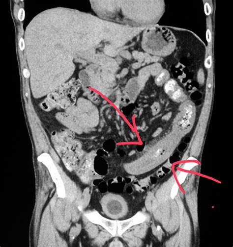 What Does A Ct Scan Of The Abdomen Show