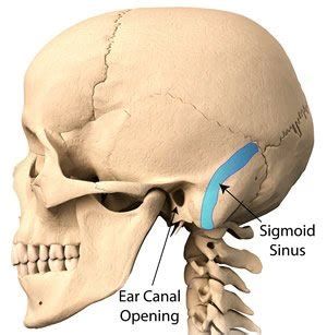 Pulsatile Tinnitus Caused by Sigmoid Sinus Dehiscence or Diverticulum ...