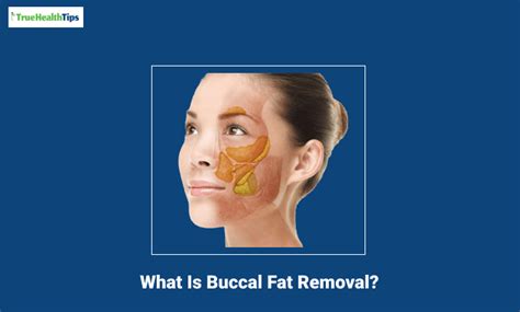 What Is Buccal Fat Removal? All You Need To Know