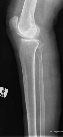 Tibial tuberosity avulsion fracture | Image | Radiopaedia.org