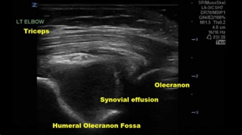 Arthrocentesis of the Elbow Joint - Internet Book Of MSK Ultrasound