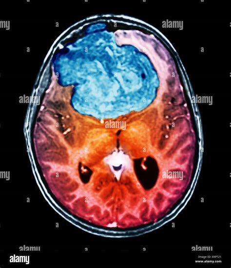 Benign brain tumour. Coloured computed tomography (CT) scan of the Stock Photo, Royalty Free ...