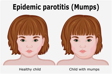 What is Parotitis or Mumps? - MECS