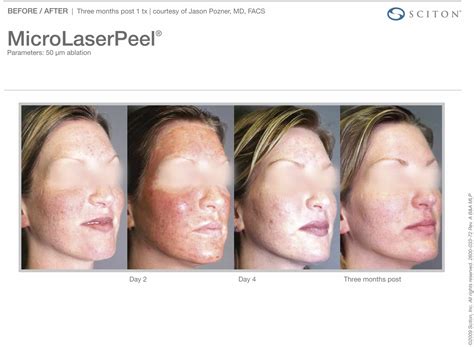 MicroLaserPeel | Ann Arbor, MI | Ganger Dermatology