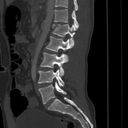 Spinal Fracture X Ray