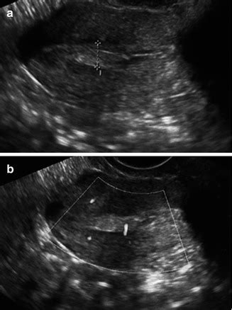 Endometrial Polyps | Radiology Key