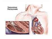 Transvenous Pacing Leads Medical Illustration Medivisuals