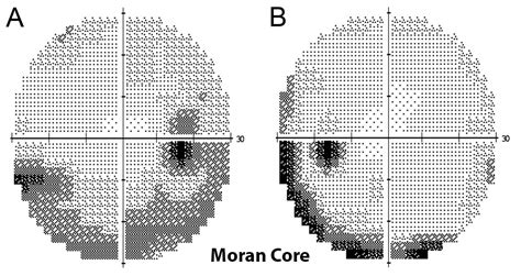 Moran CORE | Case Report of Non-Arteritic Ischemic Optic Neuropathy (NAION)