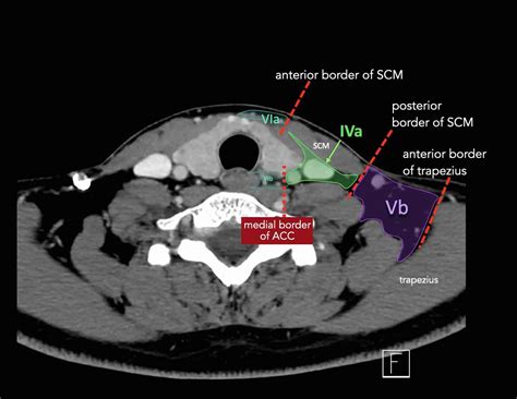 The Radiology Assistant : Cervical Lymph Node Map (2024)