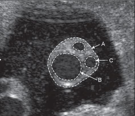 Figure 1 from Ultrasound measurements of umbilical cord transverse area in normal pregnancies ...