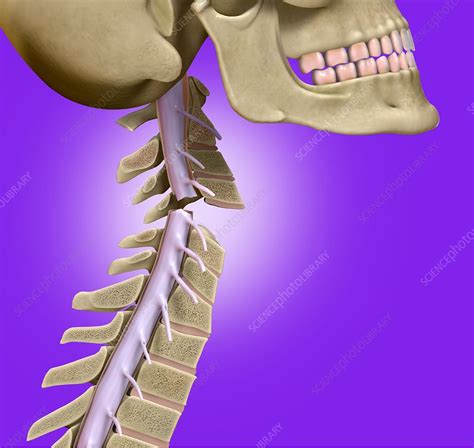 Broken neck, illustration - Stock Image - C036/3989 - Science Photo Library