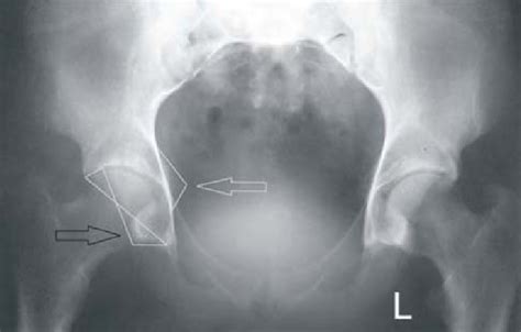 Standardized anteroposterior x-ray of the hips showing bilaterally... | Download Scientific Diagram