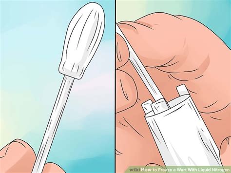 4 Ways to Freeze a Wart With Liquid Nitrogen - wikiHow