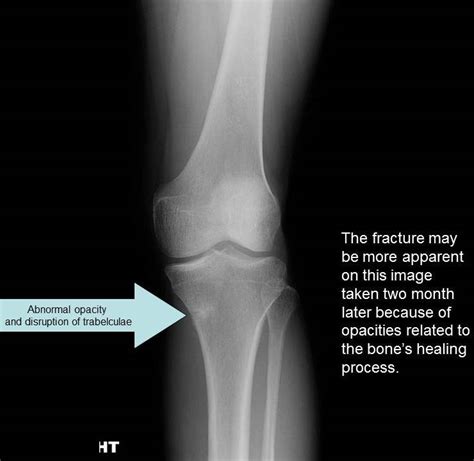 Radiography - Knee Injury and Prevention