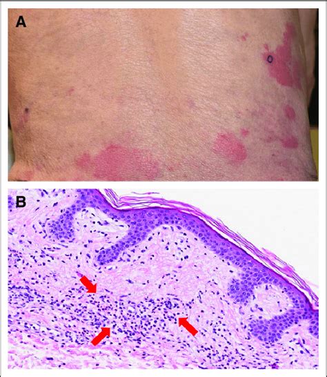 (A) Urticarial rash manifestation of Schnitzler syndrome on the ...