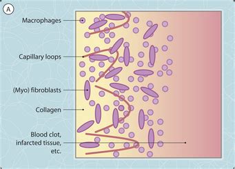 granulation tissue and fibrosis | Musculoskeletal Key