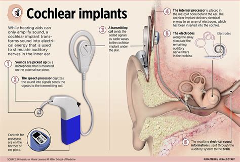 Isobel's Ears: Cochlear Implants