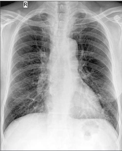 Pulmonary Vascular Markings