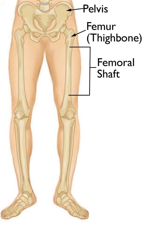 Femur Shaft Fractures (Broken Thighbone) - OrthoInfo - AAOS