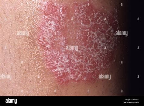 Plaque psoriasis -Fotos und -Bildmaterial in hoher Auflösung – Alamy