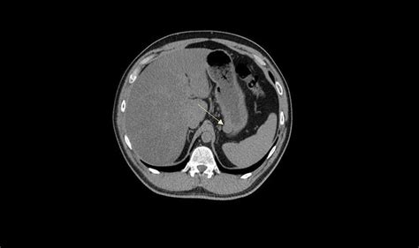 Gastrointestinal Stromal Tumor (GIST): Symptoms, Treatment, Prognosis ...